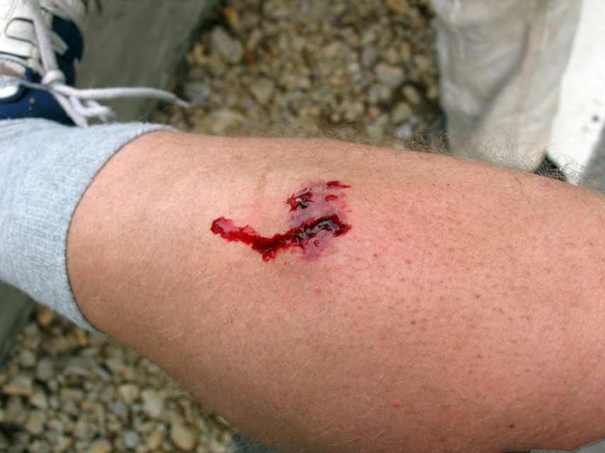 Dog bite wound on a persons leg.